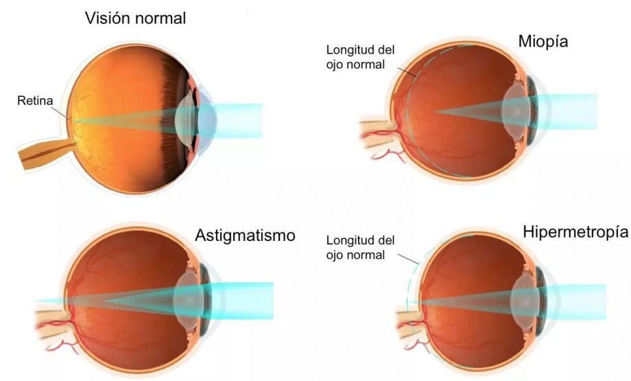 Errores Refractivos Dr Arasanz